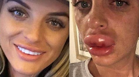 woman nearly lost top lip after getting botched fillers at botox party fox news