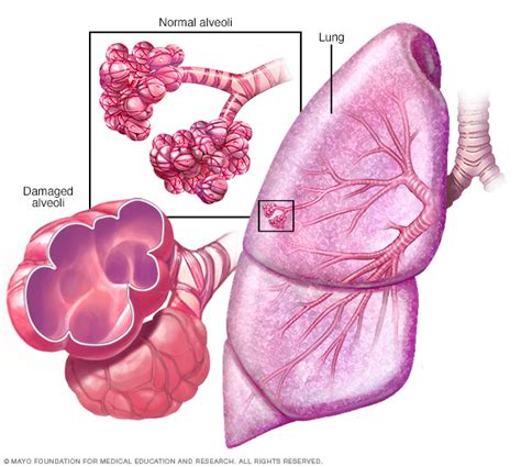Emphysema Disease Reference Guide