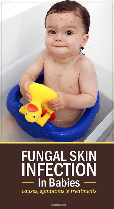 Fungal Infection In Babies Risks Treatment And Remedies Fungal