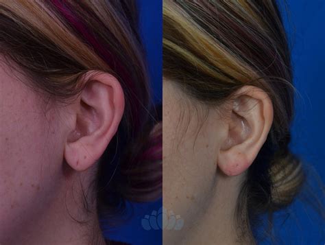 Earlobe Repair Before And After Pictures Case 80 Charlotte Nc