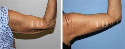 Arm Lift And Reduction Surgery Brachioplasty Before And After Karidis