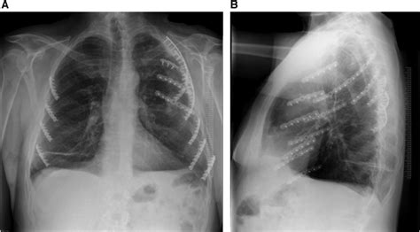 A Posterior Anterior Pa And Lateral Chest Radiograph