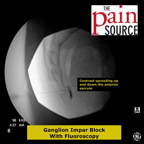 In view of the location of the sacral hiatus to the anus, strict aseptic technique is required. Ganglion Impar Block with Fluoroscopy - The Pain Source ...