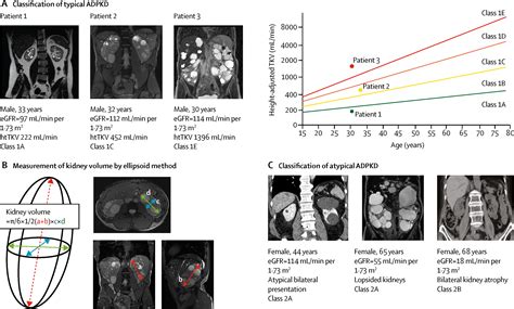Autosomal Dominant Polycystic Kidney Disease The Lancet
