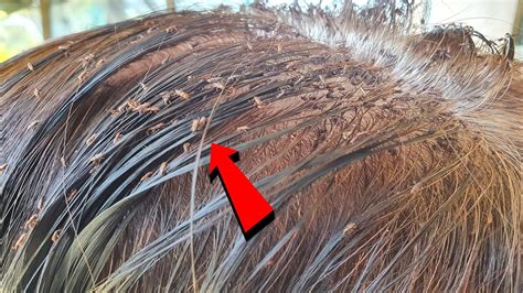 Big Head Lice Combing Giant Lice Removal On Long Hair Youtube