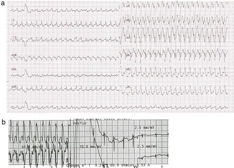 A Electrocardiograma Mostrando Una Taquicardia Regular De Qrs Ancho Download Scientific