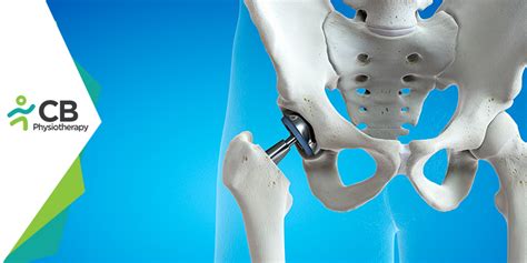 What Not To Do After Hip Replacement Surgery Blog By Cb
