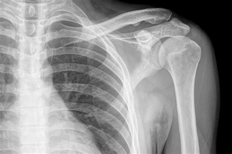 What Shoulder Blade Pain Could Mean The Healthy