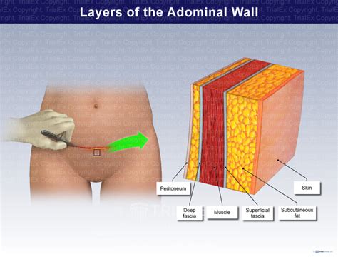 layers of the abdominal wall trial exhibits inc