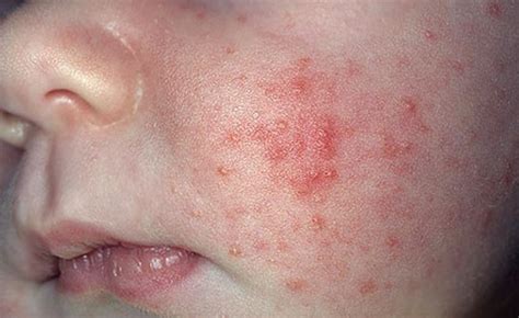 Baby Skin Rash Baby Acne Eczema Milia Miliaria Or Skincarederm
