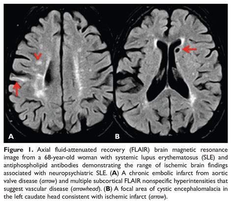 Neuropsychiatric Manifestations Of Systemic Lupus Erythematosus