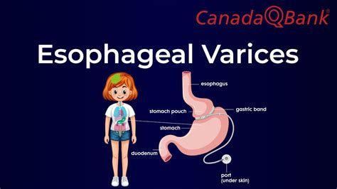 Esophageal Varices Youtube