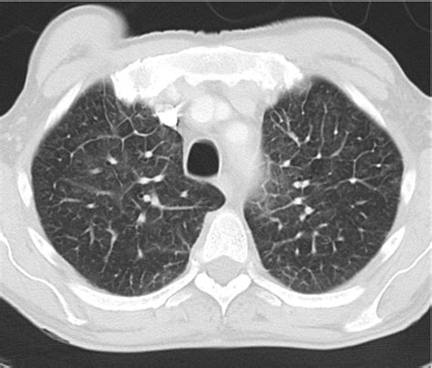Imaging Of The Lung With Interstitial Thickening Of The Interlobular