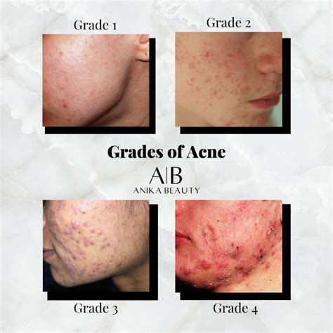 Teresa Paquin Acne And The Different Grades From One To Four How Can