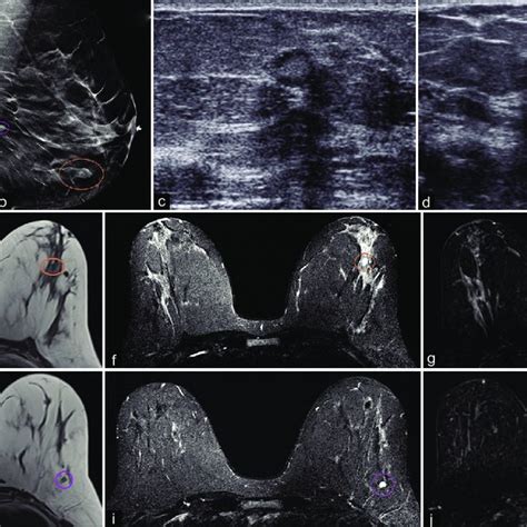 A 51 Year Old Female Had An Abnormal Screening Mammogram Cc A And