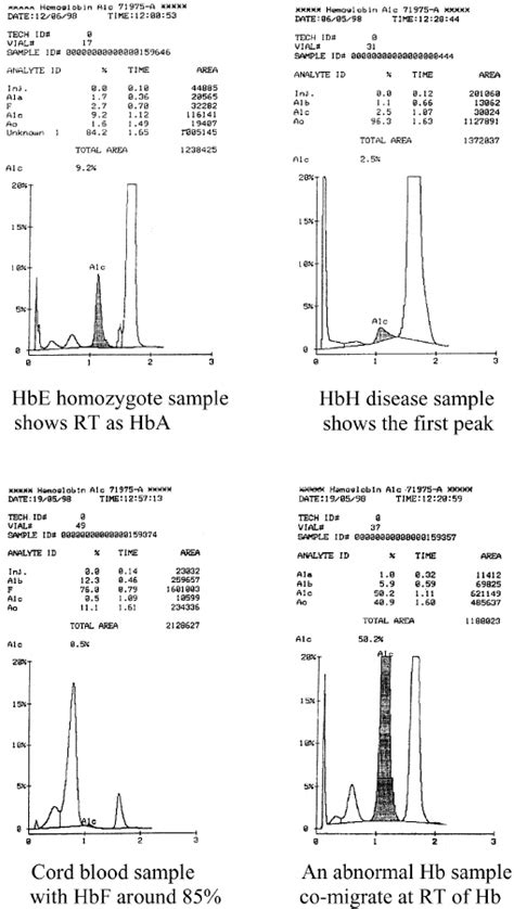 Learn what normal, low, and high levels of hemoglobin mean. The sample chromaograms from Variant Hemoglobin A1C ...