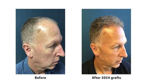 Before And After Hair Transplants Berman Skin Institute