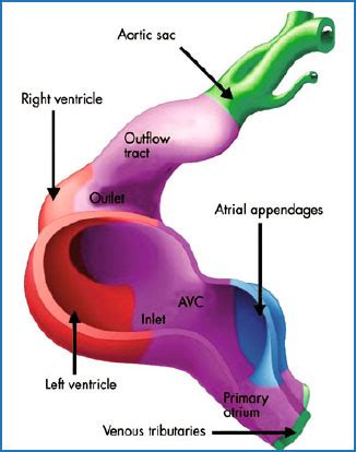 Tetralogy of fallot is defined on the basis of its phenotypic feature, namely tetralogy of fallot (tof) is a form of congenital heart disease characterized by a ventricular septal defect (vsd), an overriding aorta, right ventricular outflow tract obstruction (rvoto), and right ventricular hypertrophy. Pathophysiology in Tetralogy of Fallot | SpringerLink