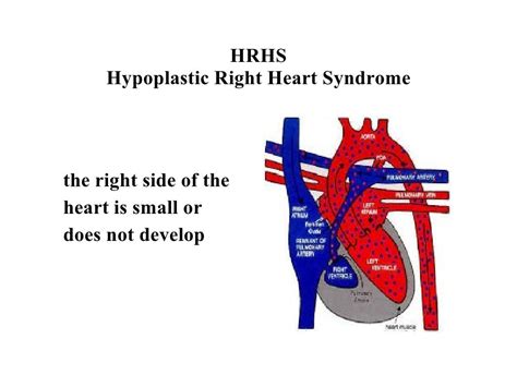 Hrhs Hypoplastic Right Heart Syndrome