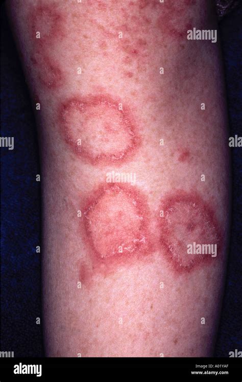 Lupus erythematosis Fotos und Bildmaterial in hoher Auflösung Alamy