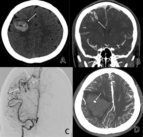 Cureus Cerebral Arteriovenous Malformation Recurrence After Complete