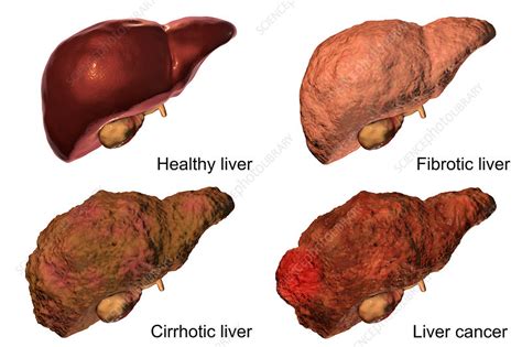 Stages Of Liver Disease Illustration Stock Image F0196460