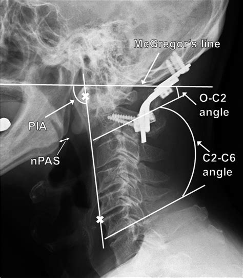 Role Of Preoperative Cervical Alignment On Postoperative Dysphagia
