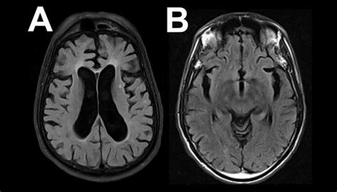 When It's Not Alzheimer's: Differential Dx of Frontotemporal Lobar ...