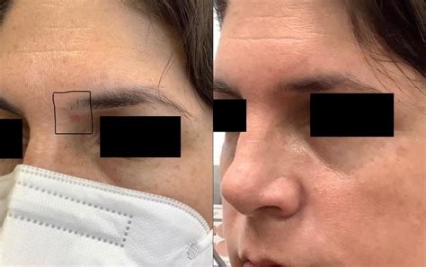 Vbeam Perfecta Before And After Photos Patient 39 Washington Dc Mi Skin Dermatology Center