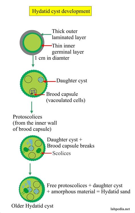 Hydatid Cyst Stages