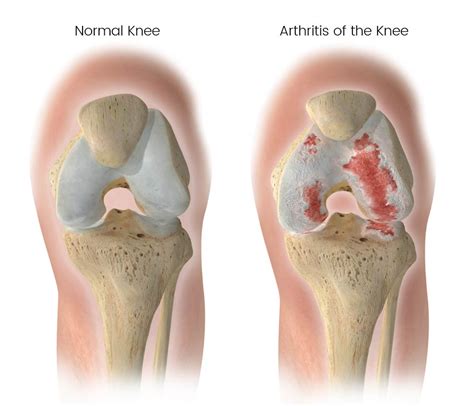 Knee Arthritis Leeds Knee And Hip