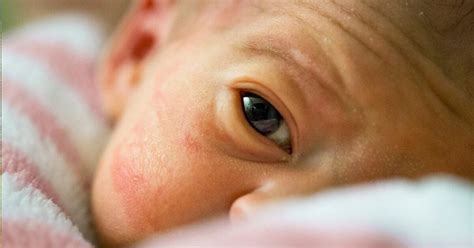 Skin Problems In The Premature Baby Healthline