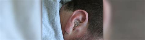 Outer Ear Infection General Center