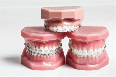 Pin On Orthodontic Insights