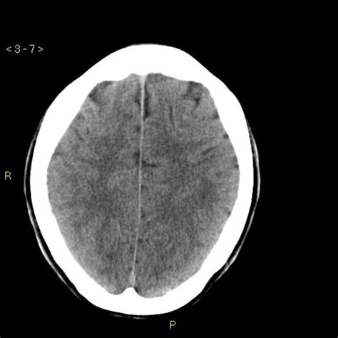 The structures generally included in the basal ganglia the separate nuclei of the basal ganglia all have extensive roles of their own in the brain, but they also are interconnected with one another to form a. Bleeding in the right basal ganglia | Radiology Case ...