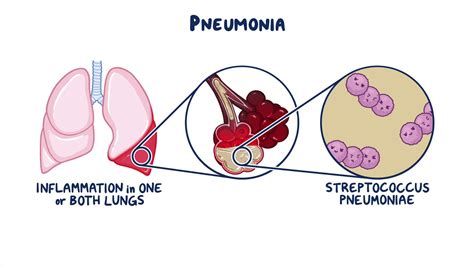 Community Acquired Pneumonia Clinical Sciences Osmosis Video Library