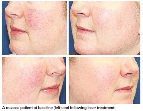 Laser Treatment Aids Rosacea Patients
