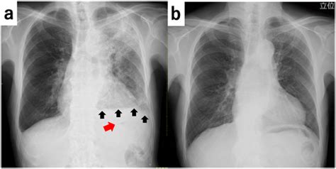 A Chest Radiograph Postero Anterior View Revealing Consolidation In