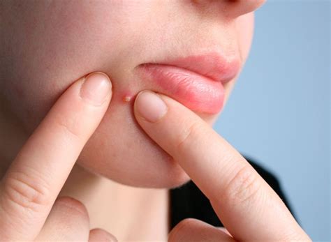 Here is what you need to know if you start noticing pimples on your cat. STOP POPPING YOUR PIMPLES TODAY!! Check this out before ...
