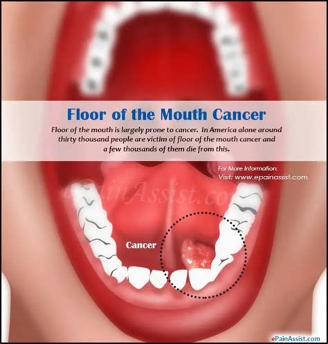 Painless Ulcers Floor Of Mouth Review Home Co