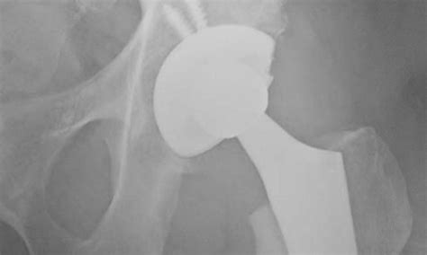 Superpath Or Superior Approach To The Hip In Total Hip Replacement