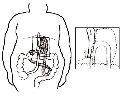 Schematic Representation Of The One Anastomosis Gastric Bypass