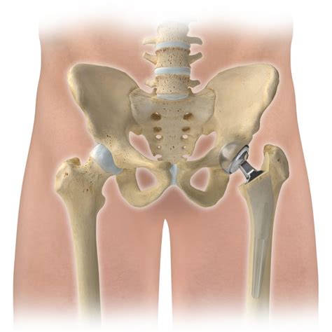 Hip Replacements May Require A Revision Why Beacon Orthopaedics