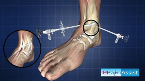 Ankle Arthroscopy Diagnostic Procedure Youtube