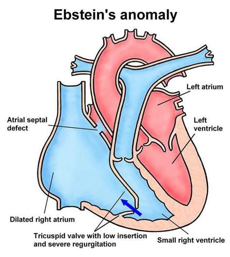 Ebstein S Anomaly Causes Symptoms Diagnosis Treatment