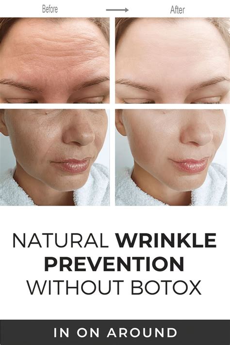 Botox Wrinkles Natural Wrinkles Prevent Wrinkles What Causes