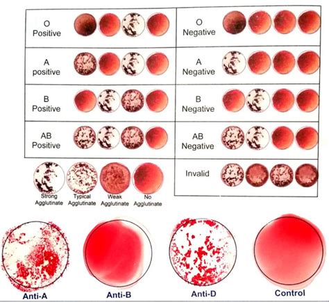 Red blood cells sometimes have another antigen, a protein known as the rhd antigen. BLOOD TYPE