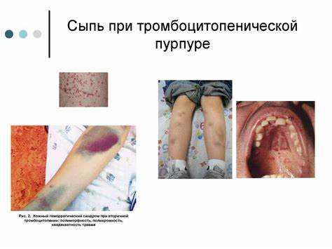 Диета при идиопатической тромбоцитопенической пурпуре Заболевания органов пищеварения у детей. Гельминтозы. Заболевания Заболевания органов пищеварения у детей. Гельминтозы. Заболевания Диета при идиопатической тромбоцитопенической пурпуре