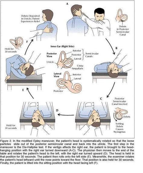 Epley Maneuver Physical Therapist Assistant Physical