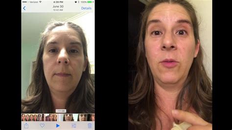 In myasthenia gravis, the voluntary muscles become weak, causing the eyelids to droop, among other problems. Ocular Documentation: Suspected Myasthenia Gravis v2 - YouTube